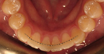 orthodontic retention pros cons retainer permanent lower bonded retainers orthodontics